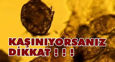 Kaşınıyorsanız dikkat !!!